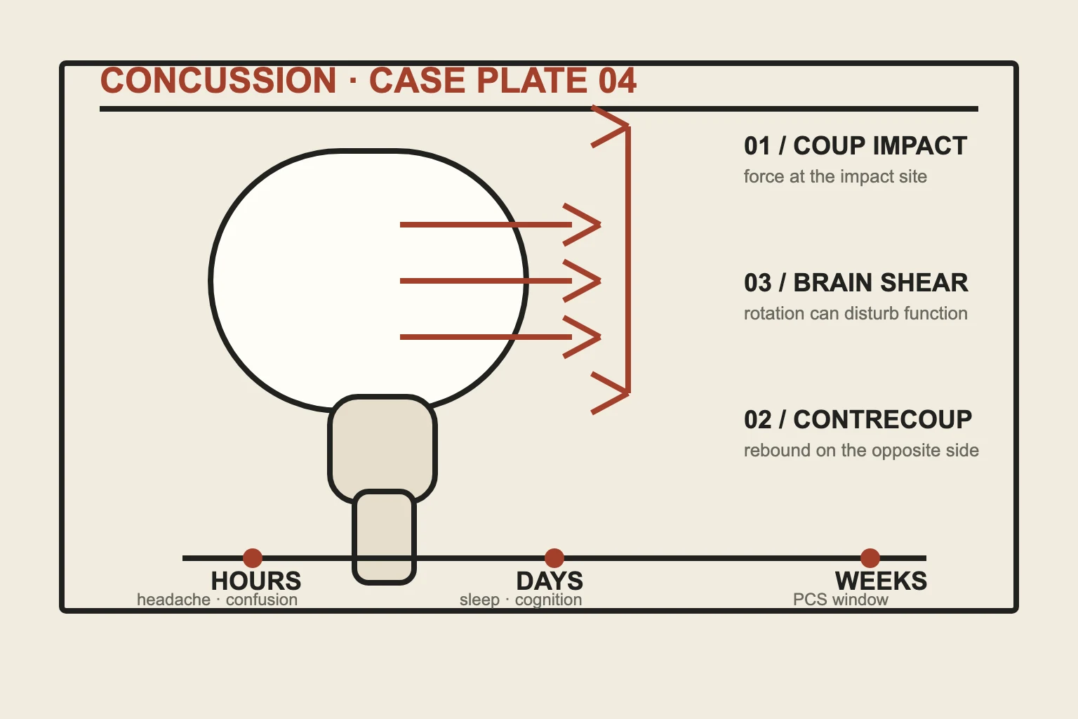 Geometric side-view concussion case plate with impact callouts and symptom timeline